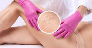 sclerotherapy-aftercare