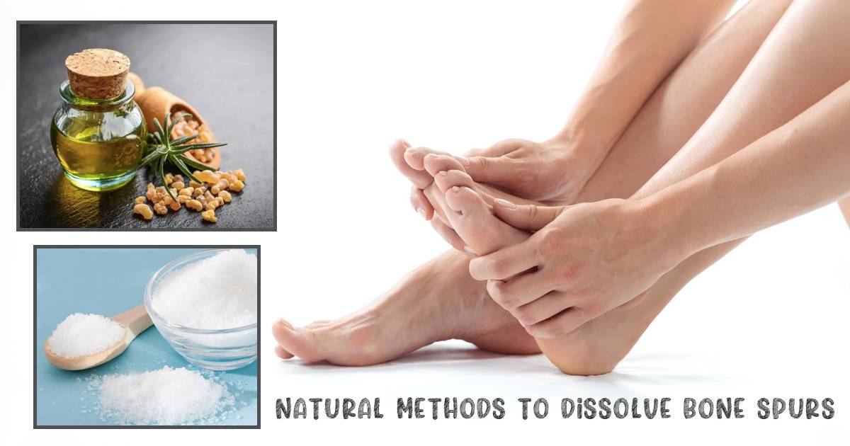 how-to-dissolve-bone-spurs-naturally