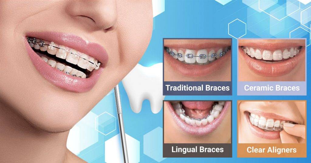 Orthodontic Appliances - Types & Their Roles In Straightening Teeth