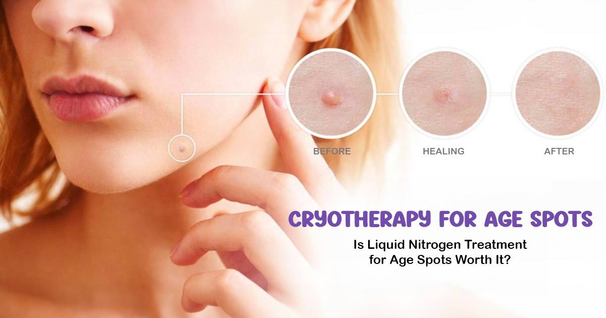 cryotherapy for age spots
