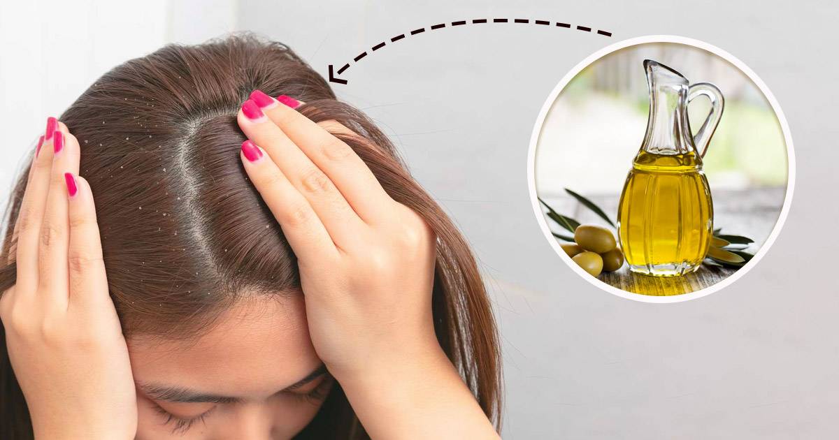 olive-oil-for-dandruff