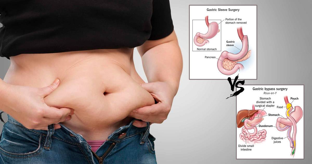 gastric sleeve VS gastric bypass