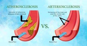 atherosclerosis-vs-arteriosclerosis