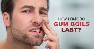 how-long-do-gum-boils-last