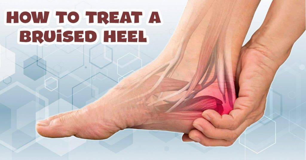 effective-methods-on-how-to-treat-a-bruised-heel