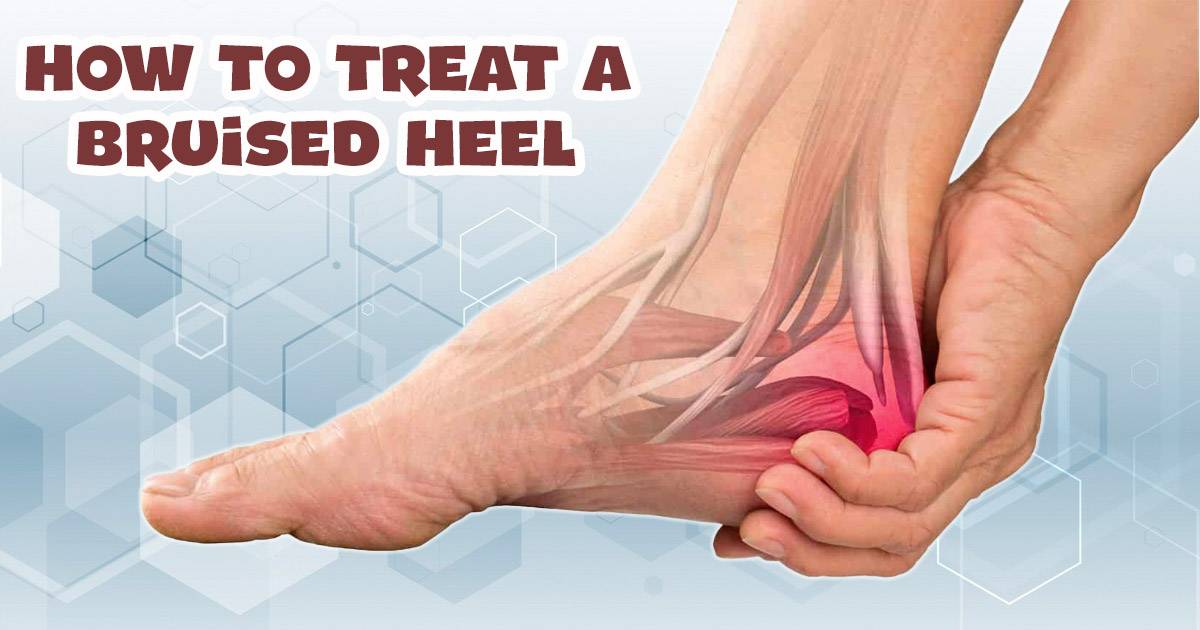 how to treat a bruised heel