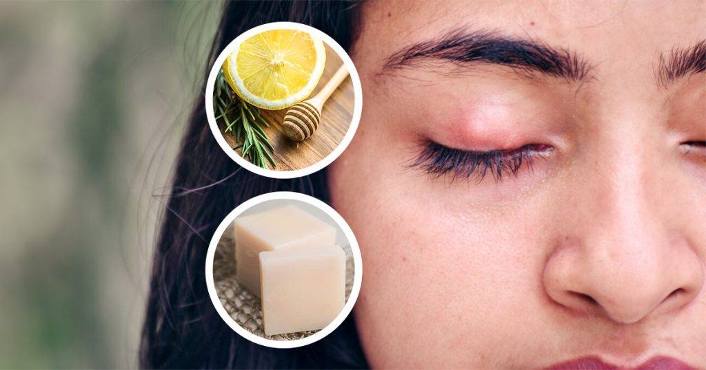 Home Treatment for Insect Bites on the Eye