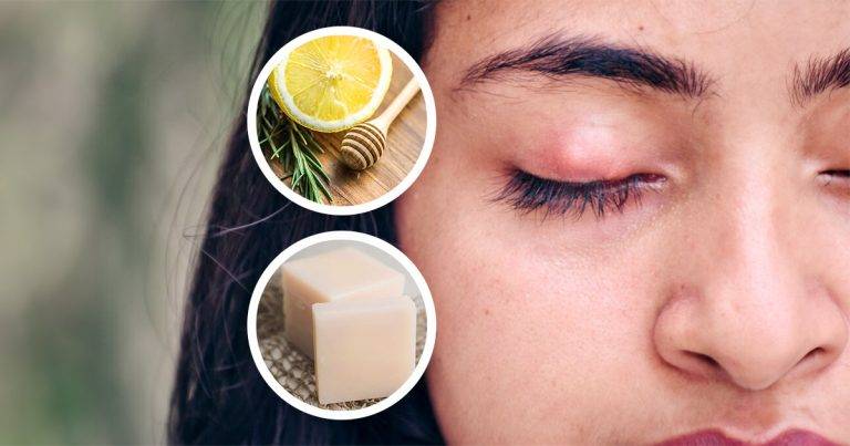 six-ways-to-naturally-relieve-mosquito-bites-remedies-for-mosquito