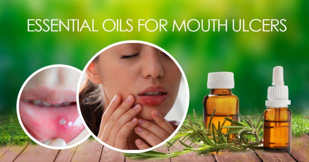 The Best Essential Oils for Mouth Ulcers