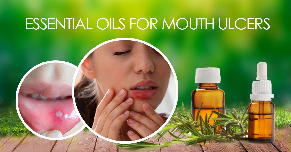 essential-oils-for-mouth-ulcers