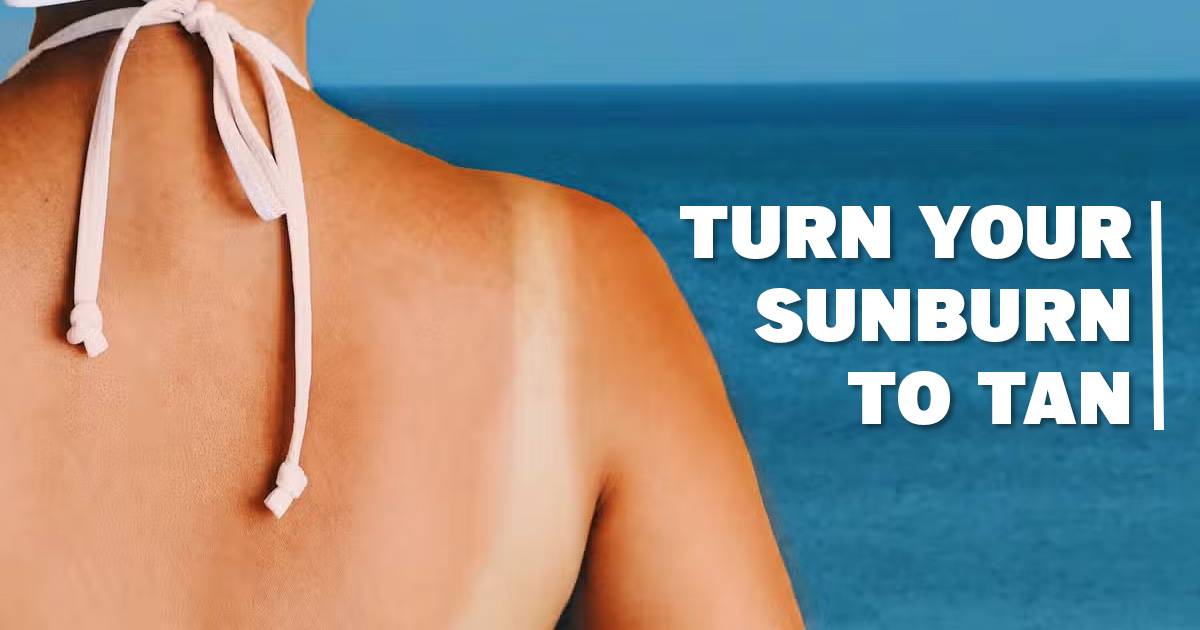 does sunburn turn into tan