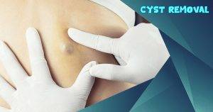 cyst removal cost without insurance