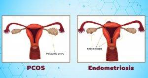 endometriosis vs pcos