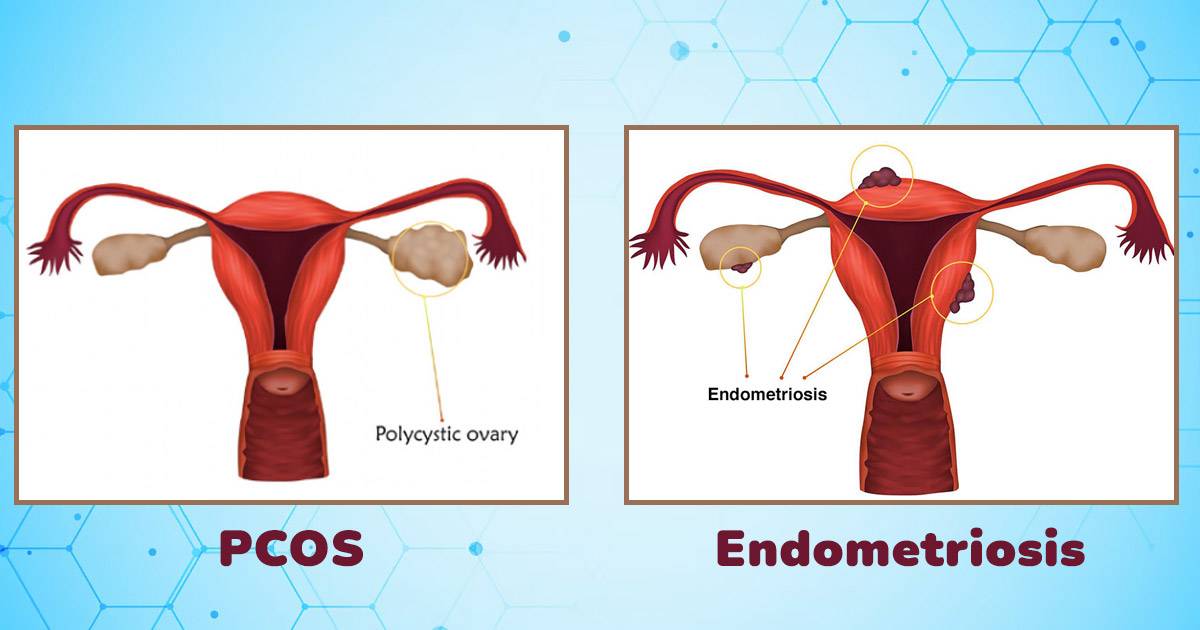 endometriosis vs pcos