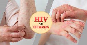 can herpes turn into HIV