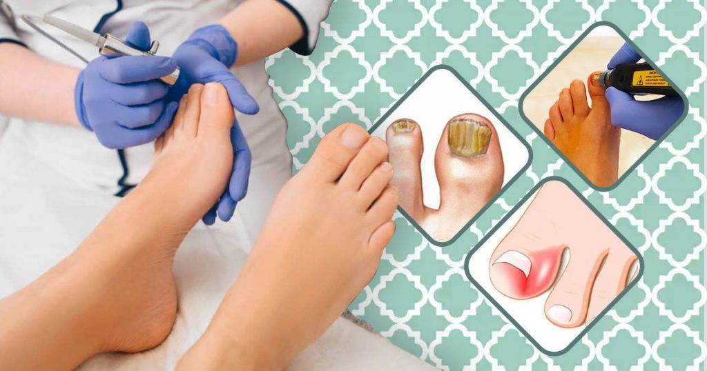 Nail Fungus Laser Treatment Factors that Affect the Costs