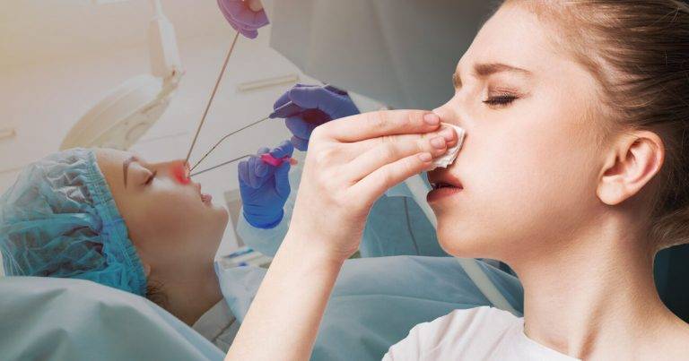 Nasal Polyp Surgery: What to Expect During Recovery