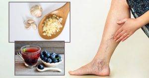 home-remedy-for-spider-veins