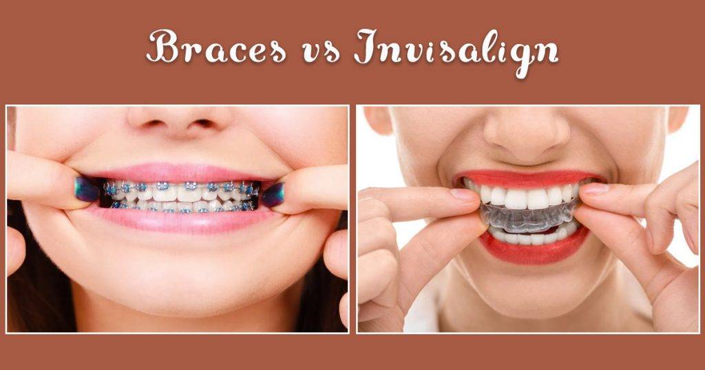 Invisalign vs. Braces Which Delivers Faster Results?