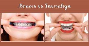 invisalign vs braces