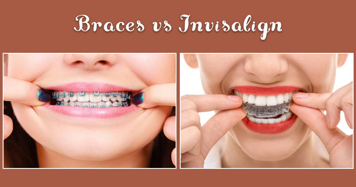 invisalign vs braces