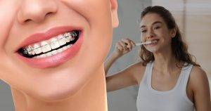 whitening teeth with braces