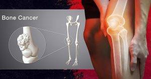 best way to detect bone cancer