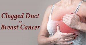 clogged duct vs breast cancer