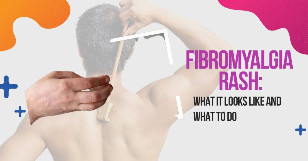 Dealing With Fibromyalgia Rash Causes & Management Tips