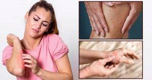 scabies vs eczema