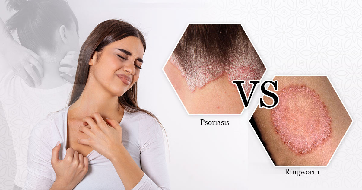 psoriasis vs ringworm