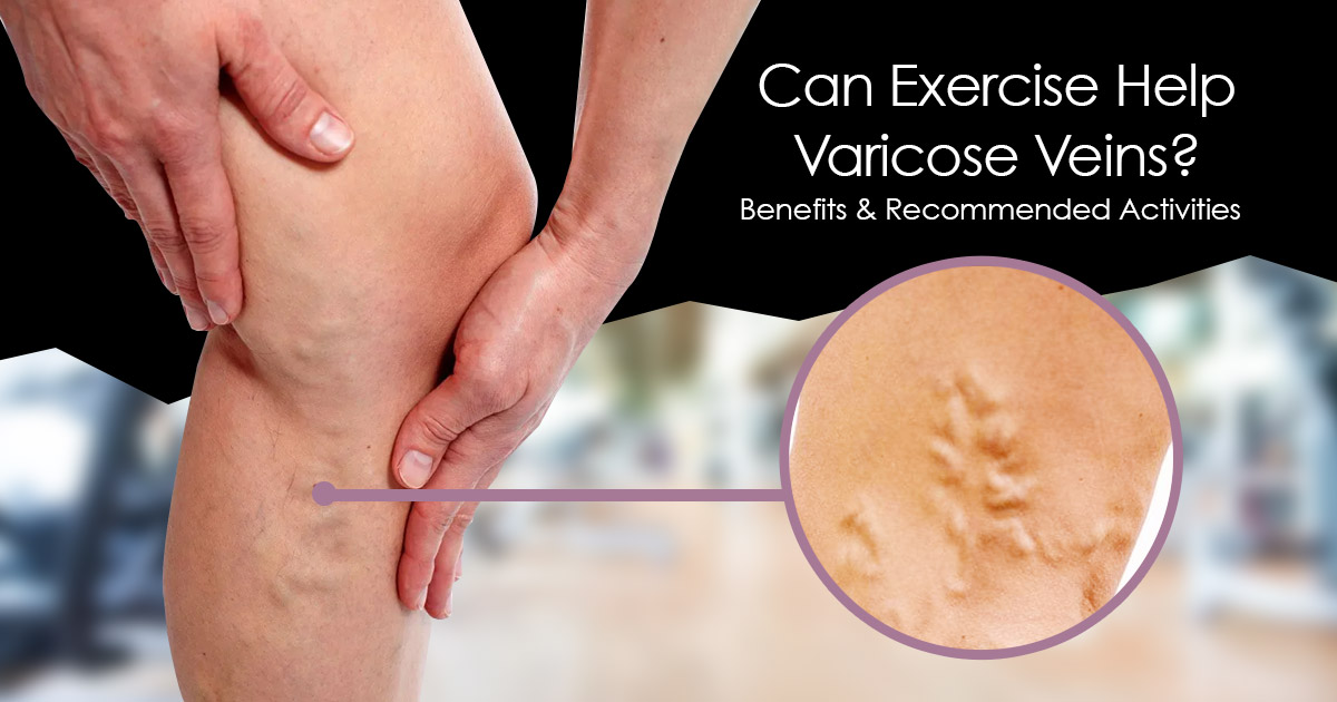 exercise help varicose veins