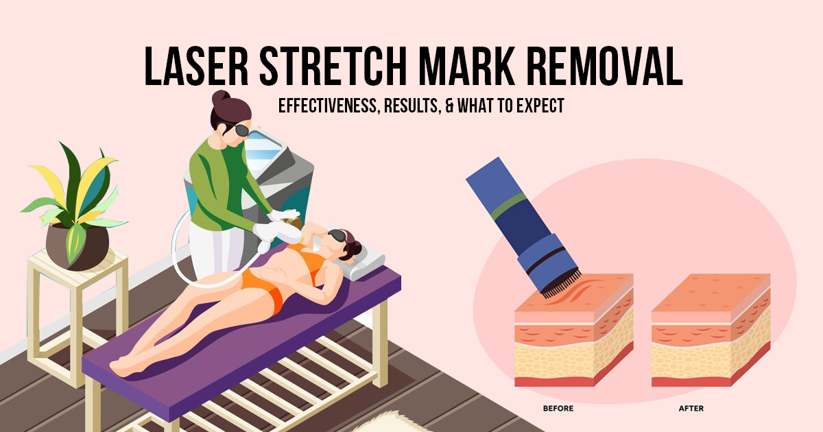 laser stretch mark removal