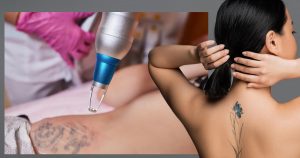 Does laser tattoo removal cause cancer