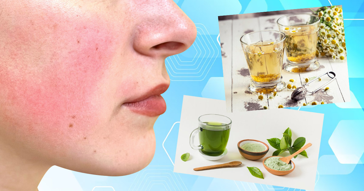 What tea is good for skin rash