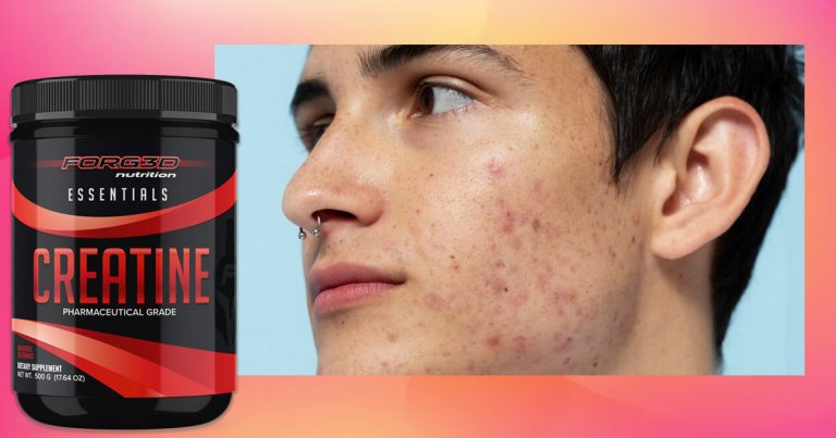 creatine and acne