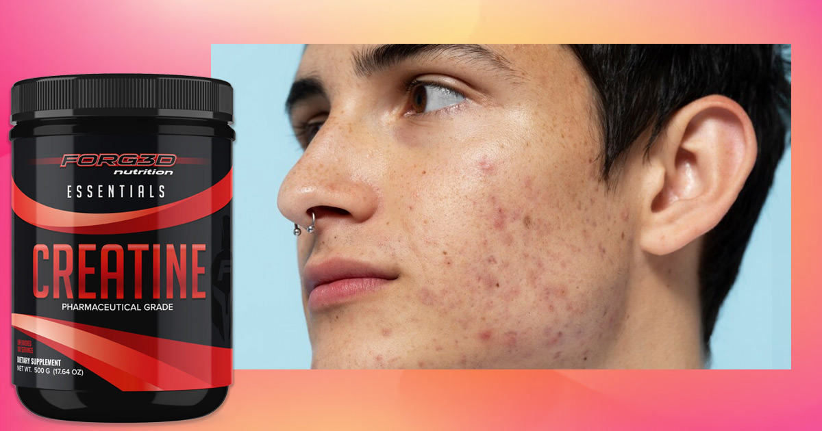 creatine and acne