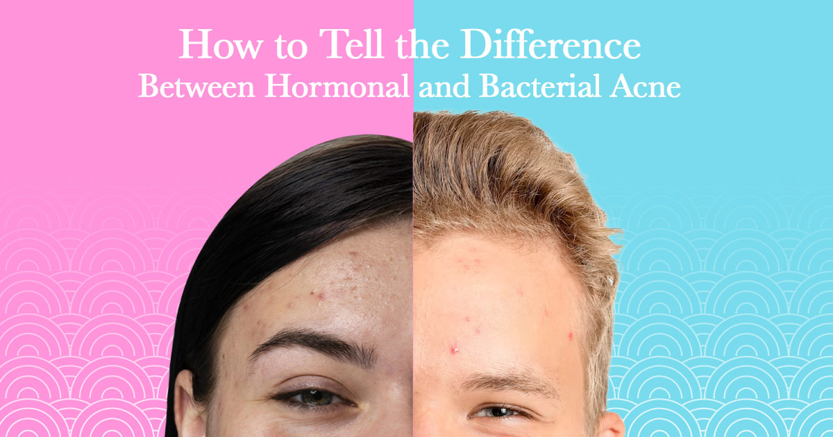 hormonal or bacterial acne