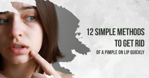 How to get rid of pimple on lip