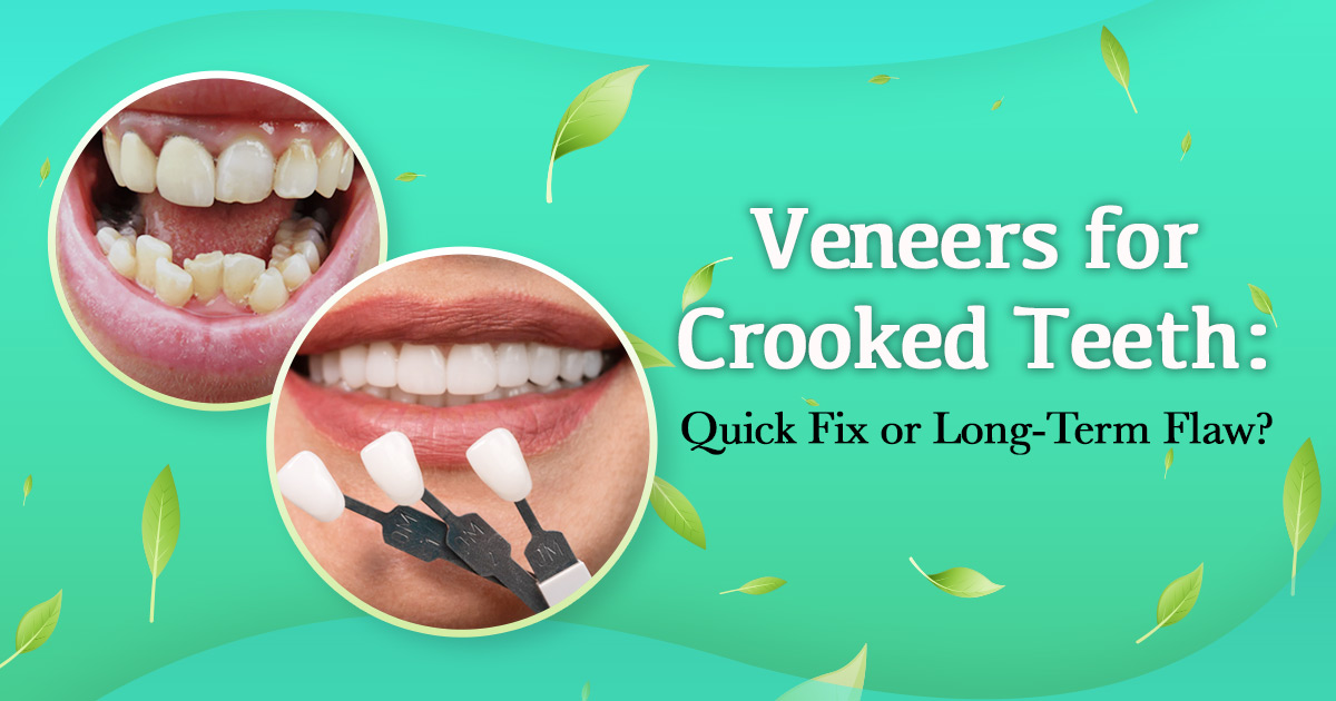 veneers-for-crooked-teeth